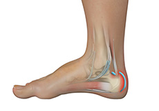 Achilles Tendon Bursitis