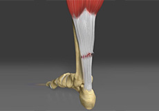 Achilles Tendon Rupture