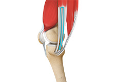 ACL Reconstruction Procedure – Hamstring Tendon 