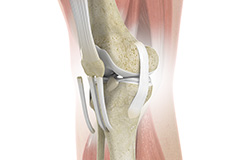 ACL Reconstruction Patellar Tendon