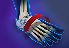 Ankle Instability