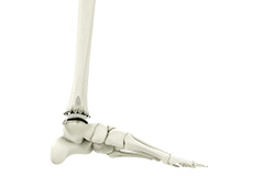 Ankle Joint Replacement