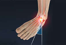 Ankle Sprain