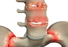 Ankylosing Spondylitis