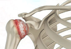 Arthritis of the Shoulder