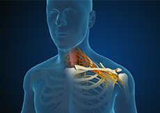 Cervical Radiculopathy/Myelopathy