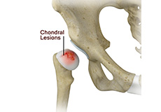 Chondral Lesions or Injuries