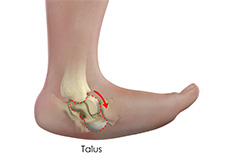 Club foot and Congenital Deformity