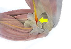 Ulnar Nerve Entrapment (Cubital Tunnel Syndrome)