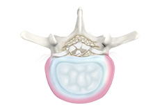 Degenerative Disc Disease