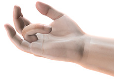 Dupuytren’s Contracture