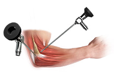 Elbow Arthroscopy