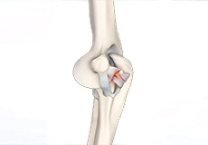 Elbow Ligament Reconstruction