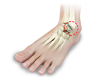 Foot & Ankle Arthritis