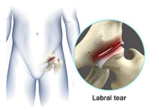 Hip Labral Tear