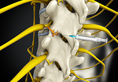 Medial Branch Block Injections