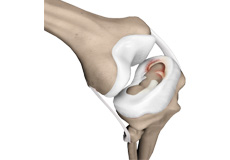 Meniscal Tears