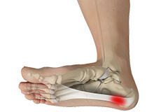 Plantar Fasciitis