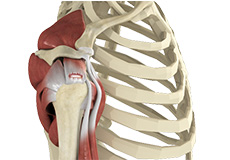 Rotator Cuff Tear