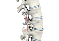 Spinal Fusion