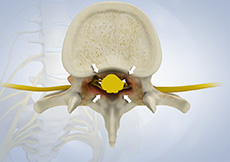 Spinal Stenosis