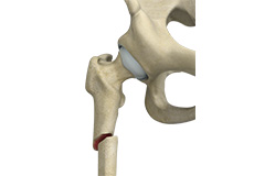 Subtrochanteric Hip Fracture