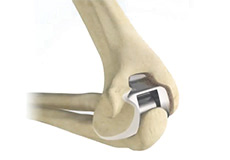 Total Elbow Replacement