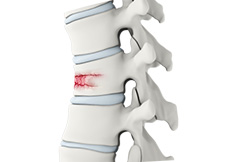 Vertebral Compression Fractures