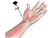 Wrist Arthroscopy