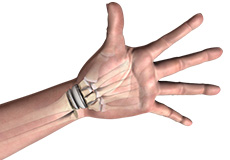 Wrist Joint Replacement